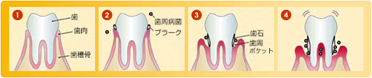 歯周病の進行順序